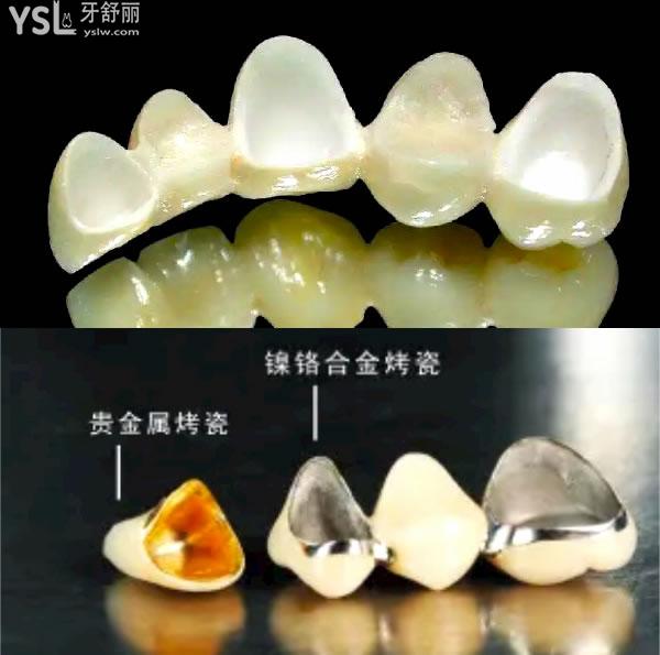 西安烤瓷牙